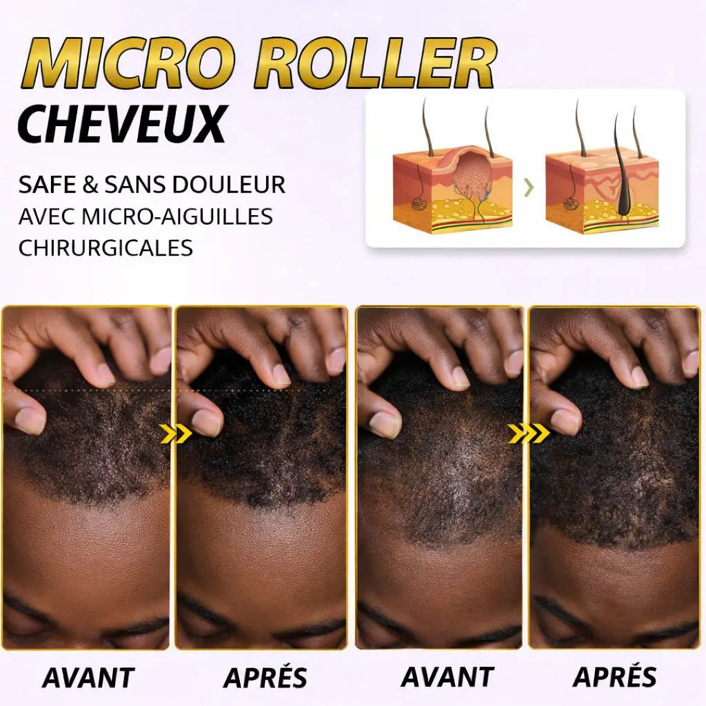 Derma Roller visage – Peau lisse, anti-acné et éclat naturel